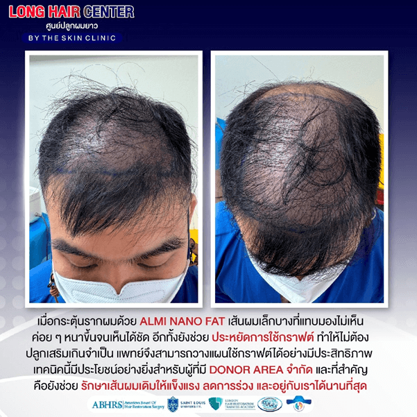 รีวิวปลูกผม: ปลูกผมผู้ชาย กู้คืนความมั่นใจด้วย เทคนิค Short Hair x ALMI Nano Fat