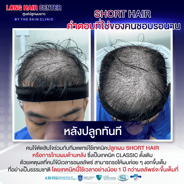 รีวิวปลูกผม: ปลูกผมผู้ชาย กู้คืนความมั่นใจด้วย เทคนิค Short Hair x ALMI Nano Fat