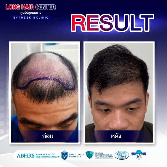 รีวิวปลูกผม: ปลูกผมผู้ชาย กู้คืนความมั่นใจด้วย เทคนิค Short Hair x ALMI Nano Fat