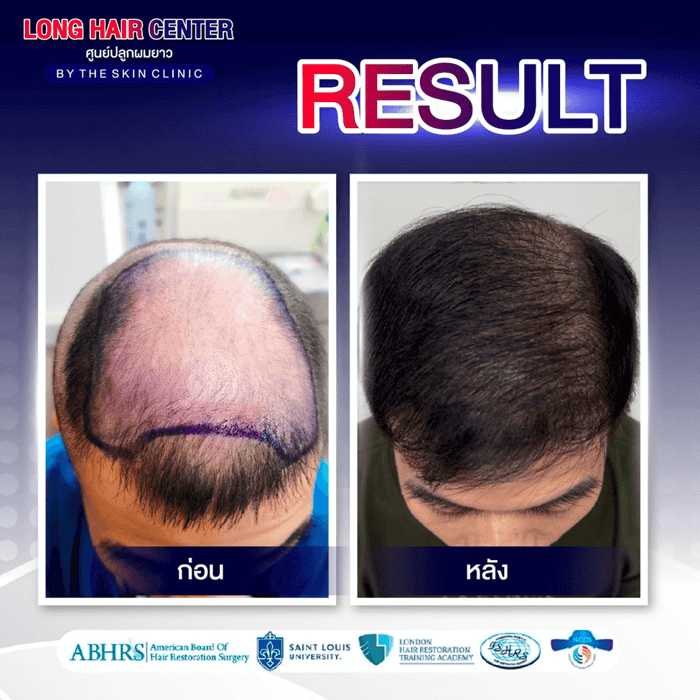 รีวิวปลูกผม: ปลูกผมผู้ชาย กู้คืนความมั่นใจด้วย เทคนิค Short Hair x ALMI Nano Fat