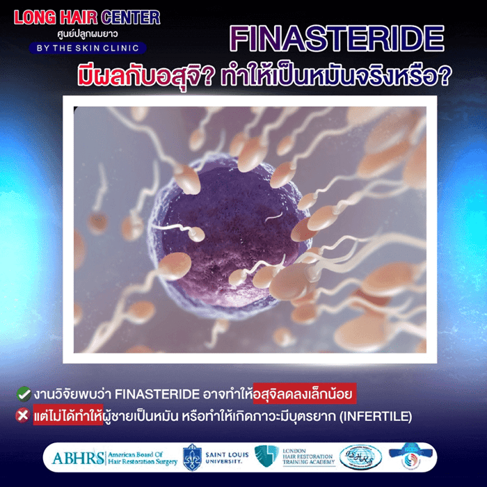10 เรื่องลับเกี่ยวกับ Finasteride และ Minoxidil: ความจริง vs ความเชื่อผิดๆ 