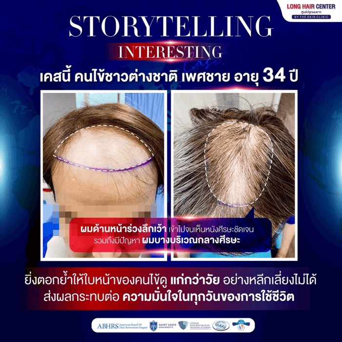 Mission Possible! รีวิวปลูกผมคนไข้เยอรมัน เปลี่ยนหัวล้านเป็นผมหนาดูดี