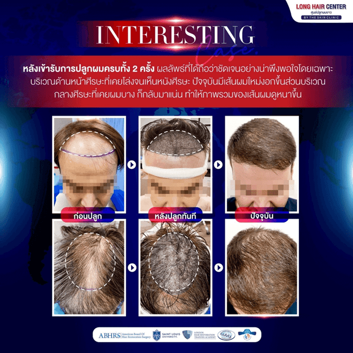 Mission Possible! รีวิวปลูกผมคนไข้เยอรมัน เปลี่ยนหัวล้านเป็นผมหนาดูดี