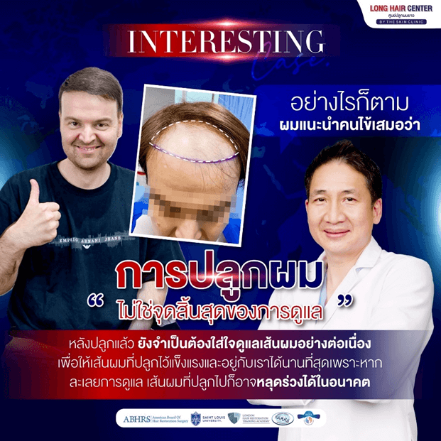 Mission Possible! รีวิวปลูกผมคนไข้เยอรมัน เปลี่ยนหัวล้านเป็นผมหนาดูดี