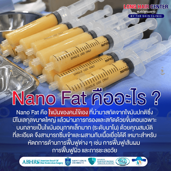 นวัตกรรมเทคนิคใหม่ของวงการปลูกผม รักษาผมบางด้วยนาโนแฟต (Nano Fat)