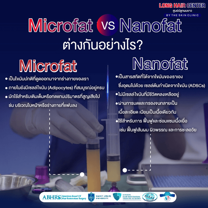 นวัตกรรมเทคนิคใหม่ของวงการปลูกผม รักษาผมบางด้วยนาโนแฟต (Nano Fat)
