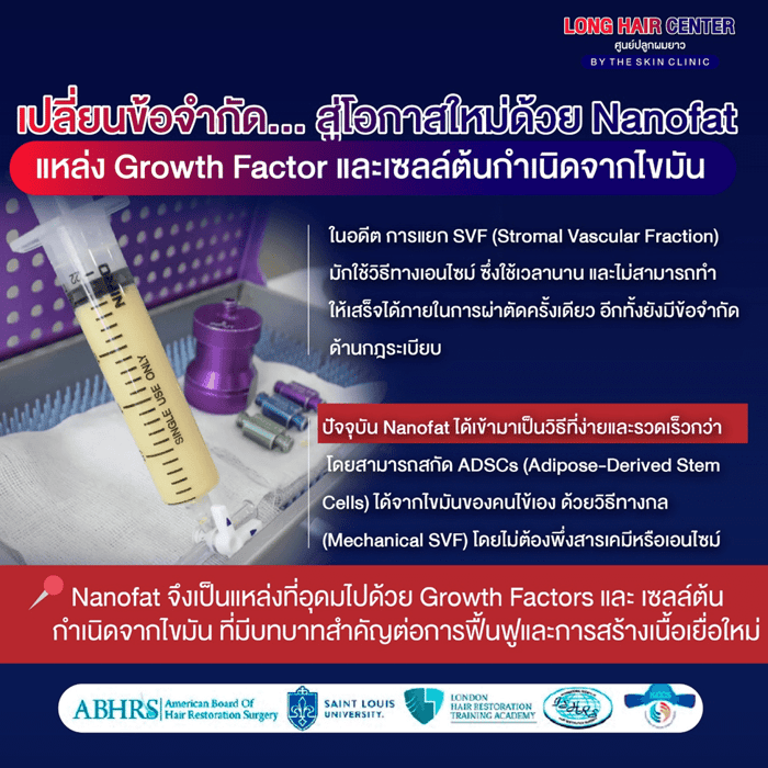 นวัตกรรมเทคนิคใหม่ของวงการปลูกผม รักษาผมบางด้วยนาโนแฟต (Nano Fat)