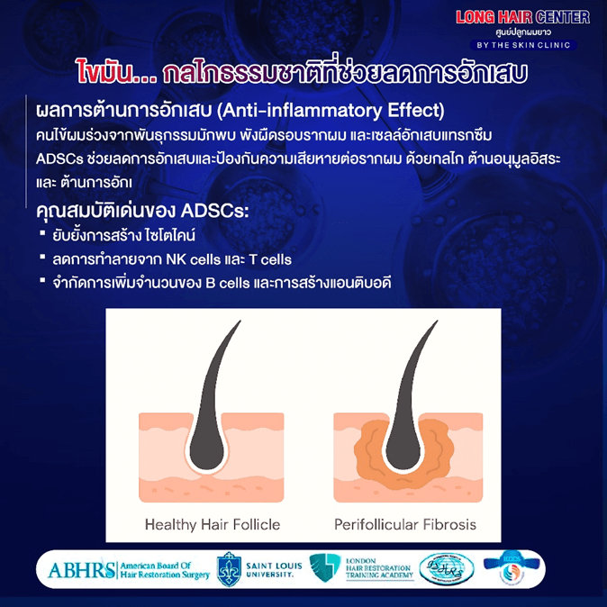 นวัตกรรมเทคนิคใหม่ของวงการปลูกผม รักษาผมบางด้วยนาโนแฟต (Nano Fat)