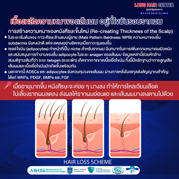 นวัตกรรมเทคนิคใหม่ของวงการปลูกผม รักษาผมบางด้วยนาโนแฟต (Nano Fat)