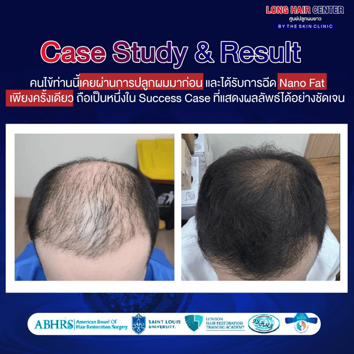นวัตกรรมเทคนิคใหม่ของวงการปลูกผม รักษาผมบางด้วยนาโนแฟต (Nano Fat)