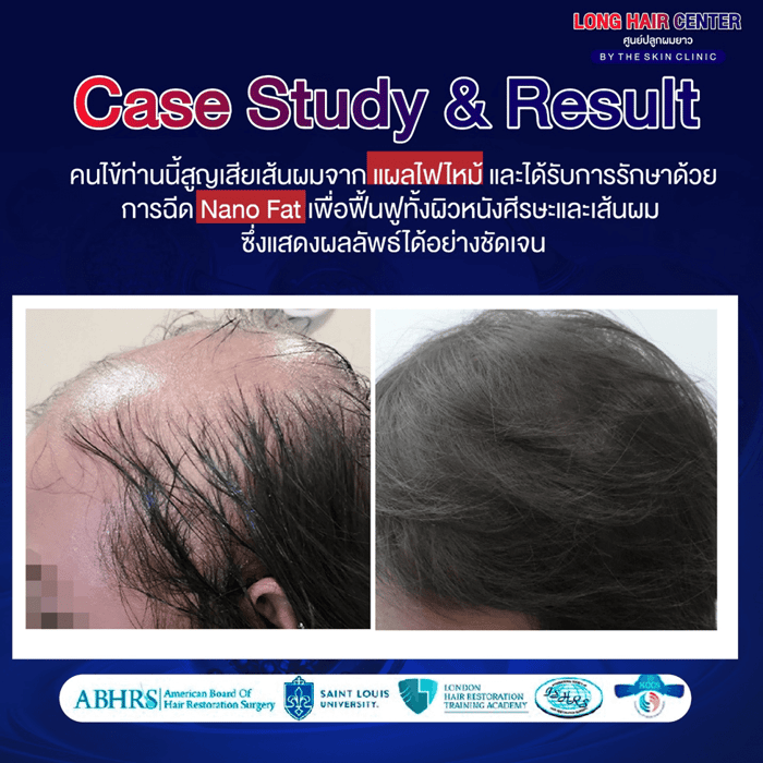 นวัตกรรมเทคนิคใหม่ของวงการปลูกผม รักษาผมบางด้วยนาโนแฟต (Nano Fat)