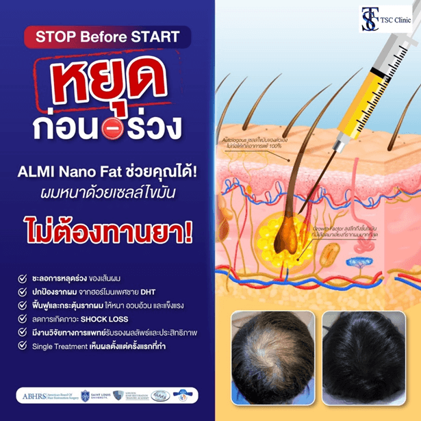 เจาะลึก Nanofat: นวัตกรรมฟื้นฟูรากผมที่แพทย์ทั่วให้ความสนใจ จากเวที FUE EUROPE 2025