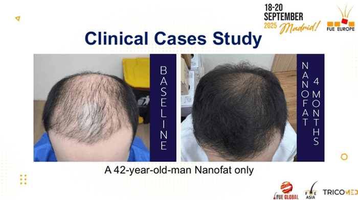 Case Study ที่หมอท๊อปนำไปเผยแพร่ในงานประชุม FUE EUROPE ครั้งที่ 13