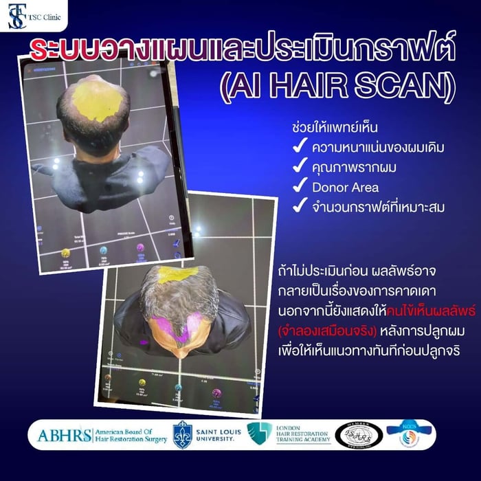 ระบบการวางแผนและประเมินกราฟต์ (AI Hair Scan)