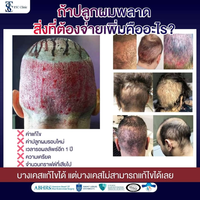 ถ้าปลูกผมพลาด สิ่งที่ต้องจ่ายเพิ่มคืออะไร?