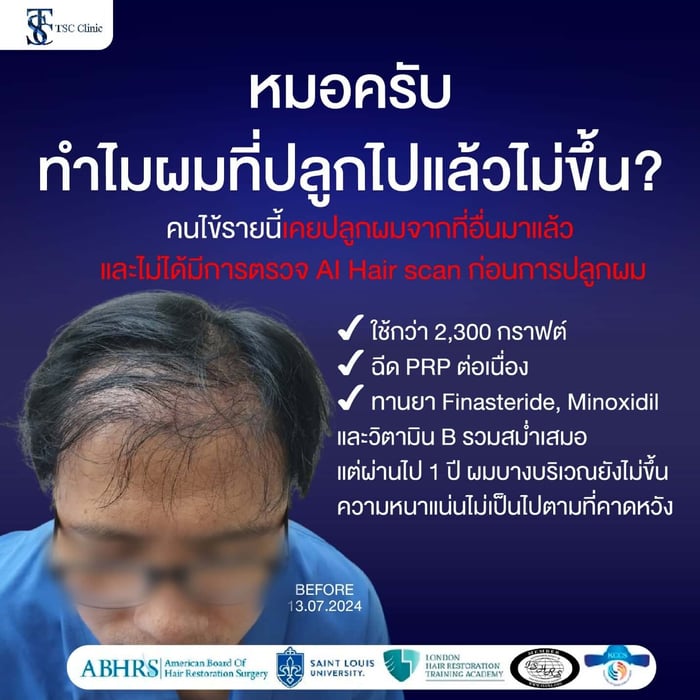 หมอครับ ทำไมผมที่ปลูกไปแล้วไม่ขึ้น