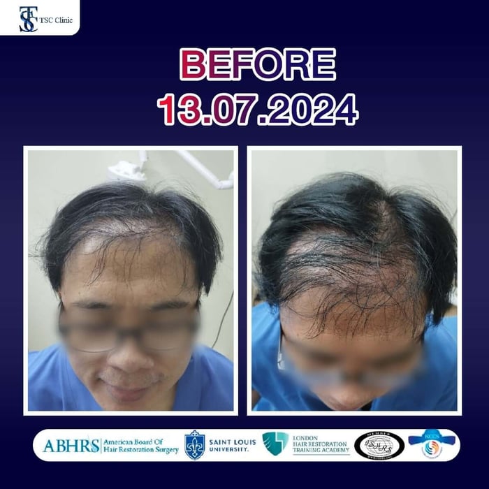 ภาพเทียบการปลูกผมช่วง Before วันที่ 13 กรกฎาคม 2024