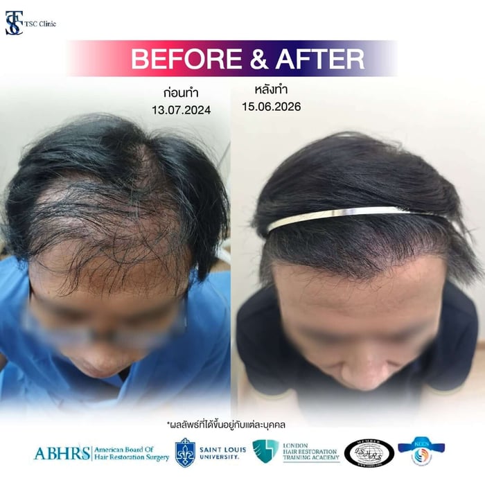 ภาพเปรียบเทียบก่อนและหลังการปลูกผมโดยหมอท๊อป ภาพก่อน (Before) ความหนาแน่นของผมบริเวณหน้าผากยังเบาบาง ส่วนภาพหลัง (After) ผมช่วงหน้าผากมีความหนาแน่นขึ้น