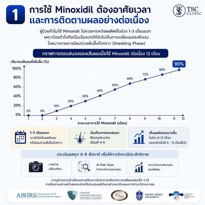 ภาพสรุปผลการใช้ Minoxidil ต้องอาศัยเวลาและการติดตามผลอย่างต่อเนื่อง โดยมีกราฟท์แสดงปริมาณเส้นผมที่เพิ่มขึ้นในช่วงเวลา 12 เดือน ถึง 90%