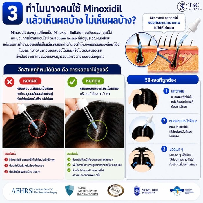 ภาพสรุปหัวข้อ ทำไมบางคนใช้ Minoxidil แล้วเห็นผลบ้าง ไม่เห็นผลบ้าง?
