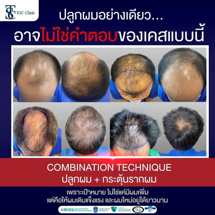 ปลูกผมอย่างเดียว... อาจไม่ใช่คำตอบของเคสนี้ Combination Technique ปลูกผม + กระตุ้นรากผม เพราะเป้าหมาย ไม่ใช่มีแค่ผมเพิ่ม แต่คือให้ผมเดิมแข็งแรง และผมใหม่อยู่ได้ยาวนาน