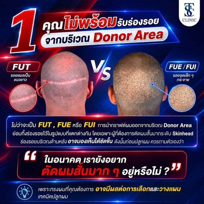 คุณไม่พร้อมรับร่องรอยจากบริเวณ Donor Area