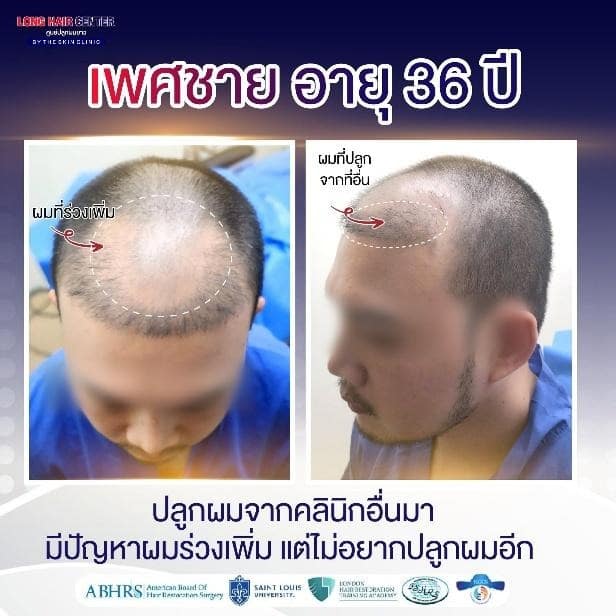 เพศชายอายุ 36 ปี ปลูกผมจากคลีนิกอื่นมา มีปัญหาผมร่วงเพิ่ม แต่ไม่อยากปลูกผมอีก