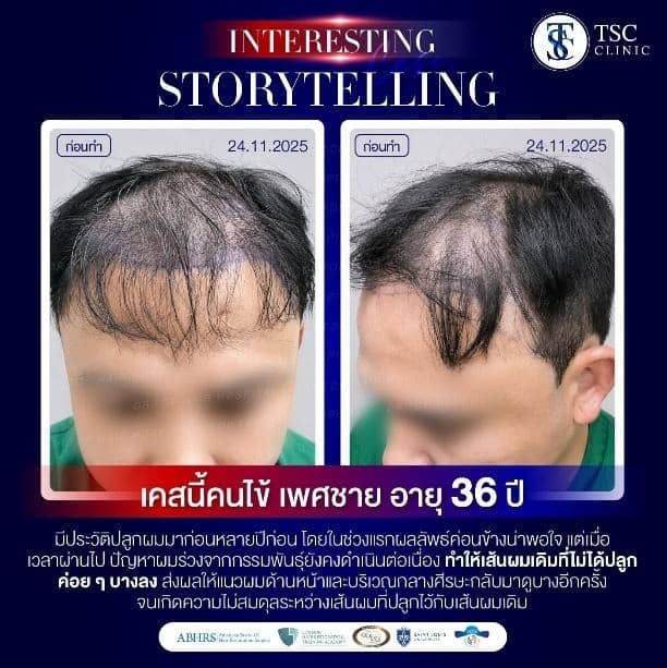 เคสนี้คนใข้ เพศชาย อายุ 36 ปี