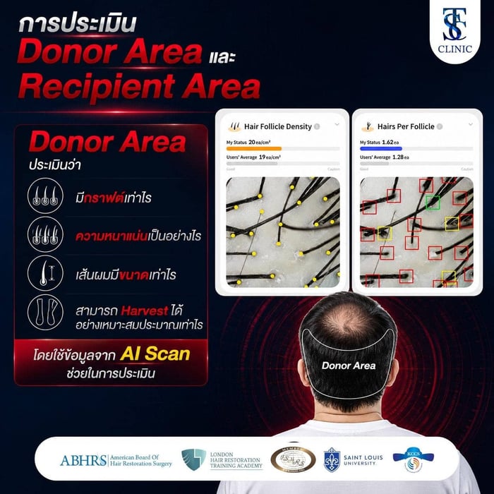 การประเมิน Donor Area และ Recipient Area ประเมิน Donor Area