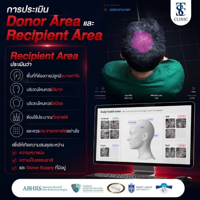 การประเมิน Donor Area และ Recipient Area ประเมิน Recipient Area