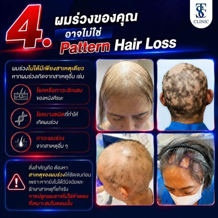 ผมร่วงของคุณ อาจไม่ใช่ Pattern Hair Loss