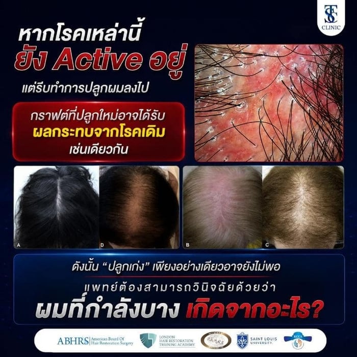 หากโรคเหล่านี้ ยัง Active อยู่ แต่รีบทำการปลูกผมลงไป กราฟต์ที่ปลูกใหม่อาจได้รับผลกระทบจากโรคเดิมเช่นเดียวกัน