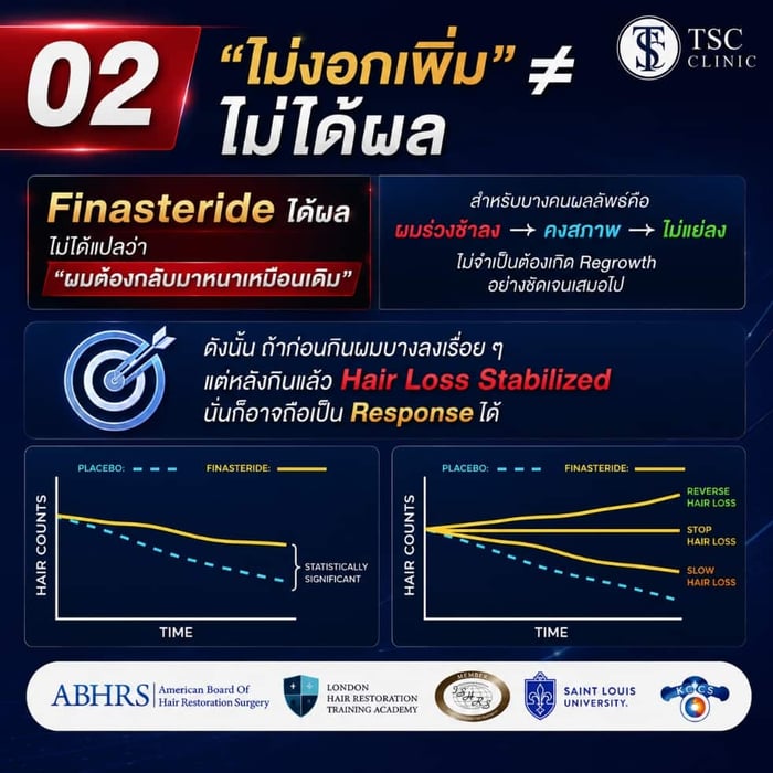02 "ไม่งอกเพิม" ไม่ได้ผล Finasteride ได้ผล ไม่ได้แปลว่า "ผมต้องกลับมาหนาเหมือนเดิม"