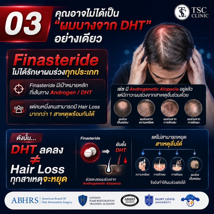 03 คุณอาจไม่ได้เป็น "ผมบางจาก DHT" อย่างเดียว