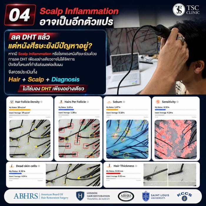 04 Scalp Inflammation อาจเป็นอีกตัวแปร ลด DHT แล้ว แต่หนังศีรษะยังมีปัญหาอยู่?