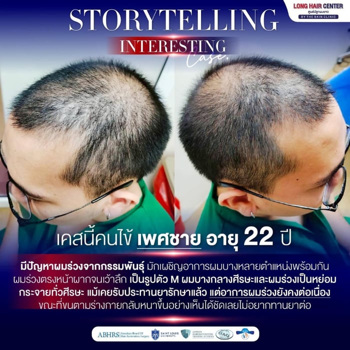 เคสนี้คนไข้ เพศชาย อายุ 22 ปี มีปัญหาผมร่วงจากกรรมพันธุ์ มักเผชิญอาการผมบางหลายตำแหน่งพร้อมกัน ผมร่วงตรงหน้าผากจนเว้าลึก เป็นรูปตัว M ผมบางกลางศีรษะและผมร่วงเป็นหย่อม กระจายทั่วศีรษะ แม้เคยรับประทานยารักษาแล้ว แต่อาการผมร่วงยังคงต่อเนื่อง ขณะที่ขนตามร่างกายกลับหนาขึ้นอย่างเห็นได้ชัดเลยไม่อยากทานยาต่อ