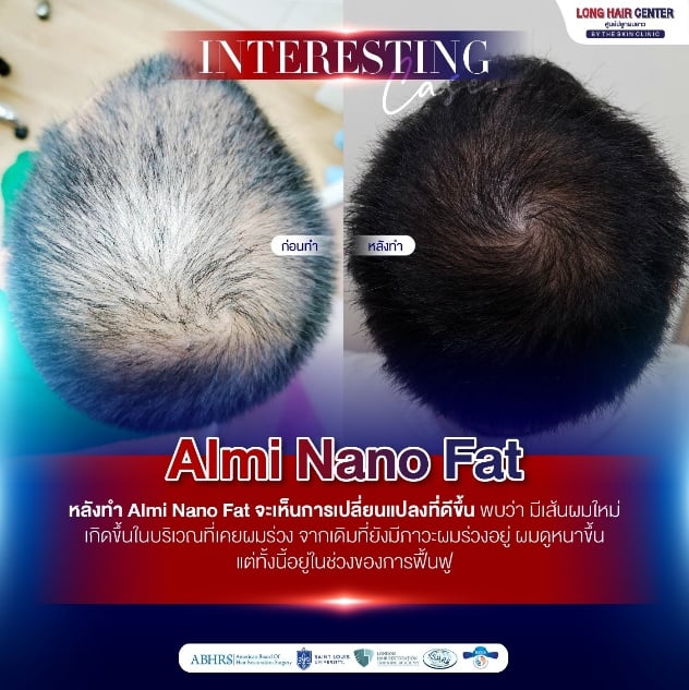 หลังทำ Almi Nano Fat จะเห็นการเปลี่ยนแปลงที่ดีขึ้น พบว่า มีเส้นผมใหม่ เกิดขึ้นในบริเวณที่เคยผมร่วง จากเดิมที่ยังมีภาวะผมร่วงอยู่ ผมดูหนาขึ้น แต่ทั้งนี้อยู่ในช่วงของการฟื้นฟู