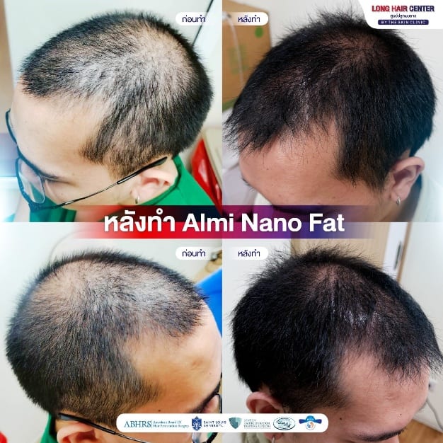 ภาพเปรียบเทียบก่อนและหลังทำ ALMI Nano Fat