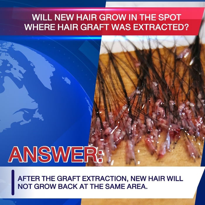 Every extracted hair graft is suitable for transplantation?