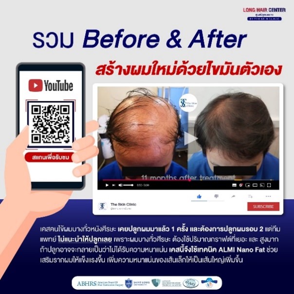 ปลูกผมที่ไหนดี, ศัลยกรรมปลูกผม