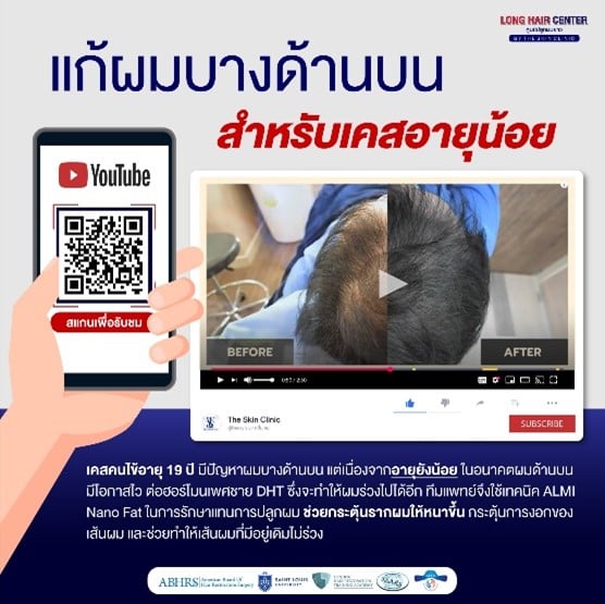 FUE Hair Transplant, Hair Transplant