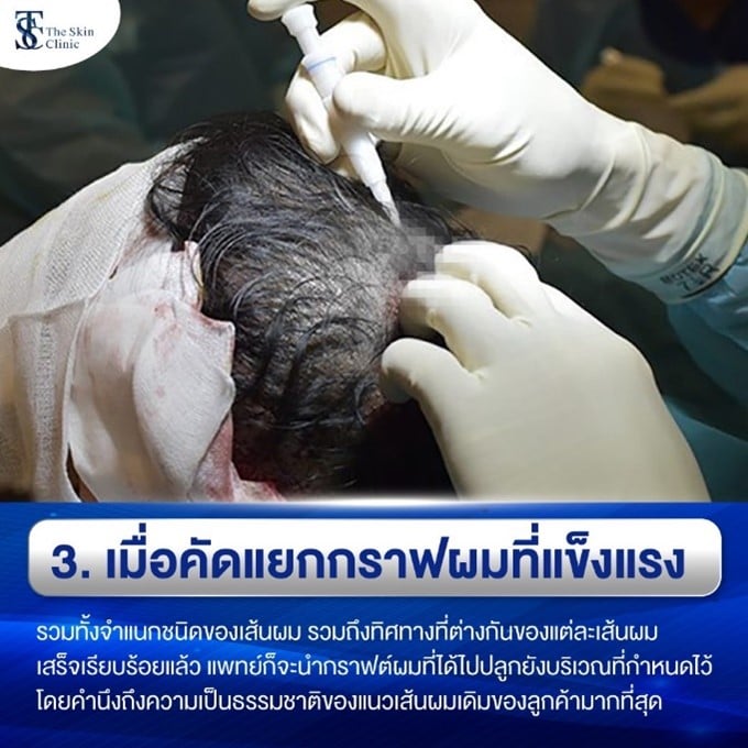 คัดเลือกกราฟต์ผมที่ดี