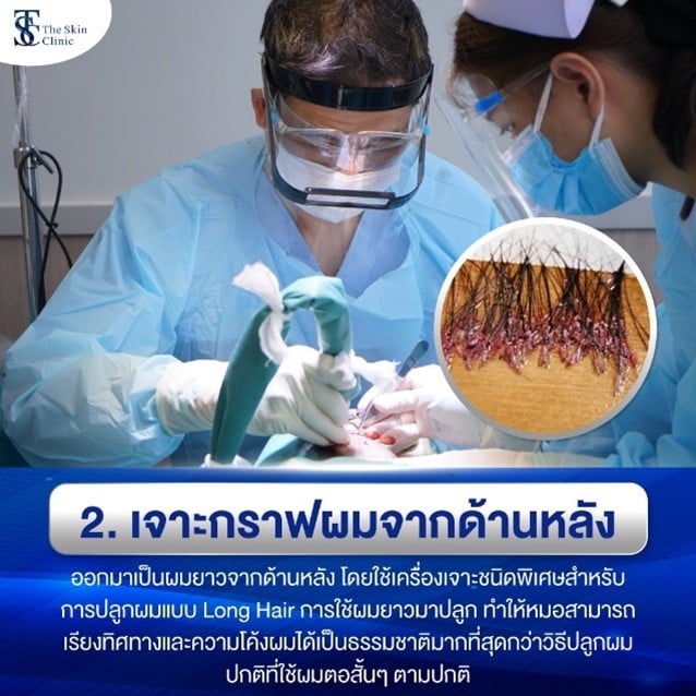 ถอนกราฟต์ผมยาว