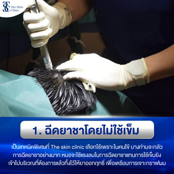 ฉีดยาชาโดยไม่ใช้เข็ม