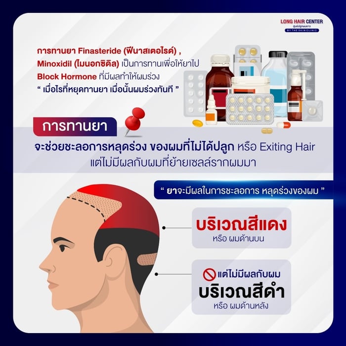 ก่อนเข้ารับการรักษาด้วยการปลูกผม หลายคนอาจสงสัยว่า“ปลูกผมแล้วต้องกินยาหรือไม่ ต้องกินตลอดชีวิตไหม ?” เพราะคิดว่าปลูกผมแล้วจะสามารถแก้ปัญหาผมบาง ศีรษะล้านได้ทั้งหมด