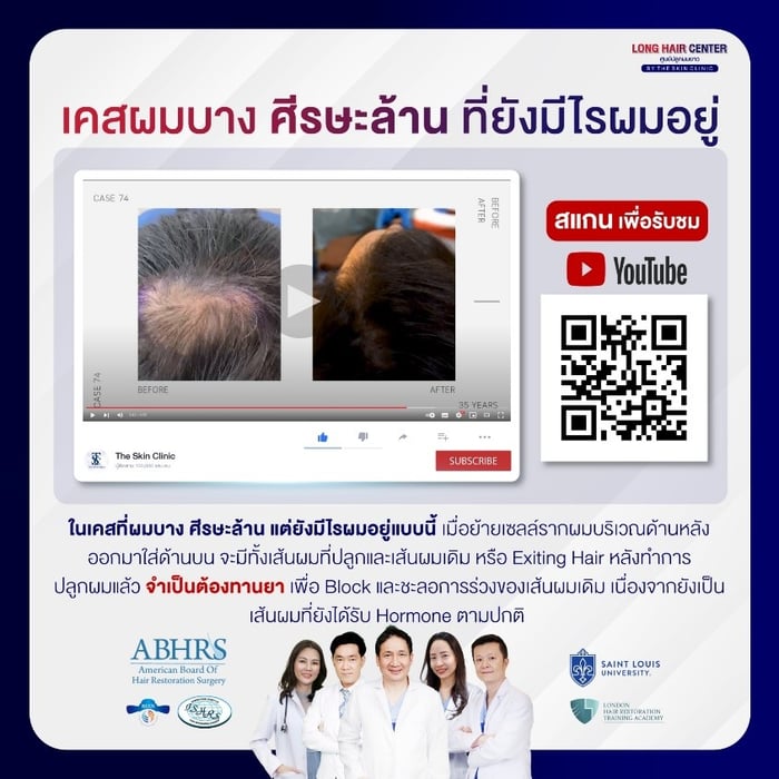 กรณีคนไข้ที่ปลูกผมเพื่อเติมแค่บางส่วนบริเวณกลางศีรษะ และมีแนวโน้มที่จะเจอกับปัญหาผมบางลงเรื่อยๆ จนเหลือแต่ผมที่ปลูก ในอนาคตอาจจะต้องปลูกผมใหม่เพื่อเติมตรงช่องว่าง  แบบนี้จำเป็นต้องทานยา 