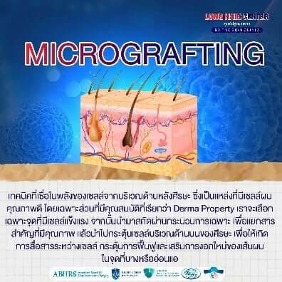 เทคนิค Regenera Micrograft Hair มีข้อดีอย่างไร?