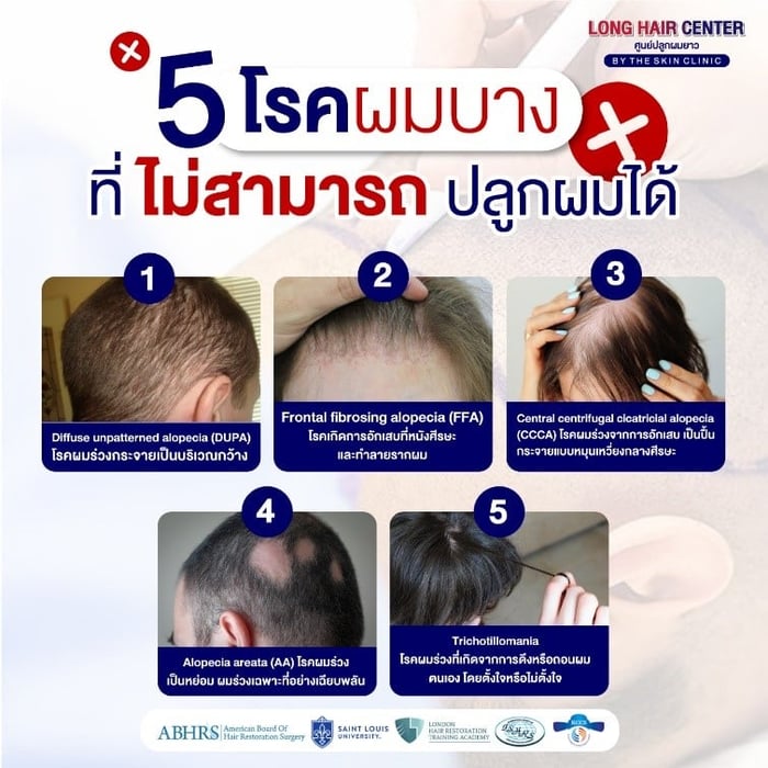 ปลูกผมที่ไหนดี? สิ่งที่ควรพิจารณาก่อนตัดสินใจปลูกย้ายเซลล์รากผม
