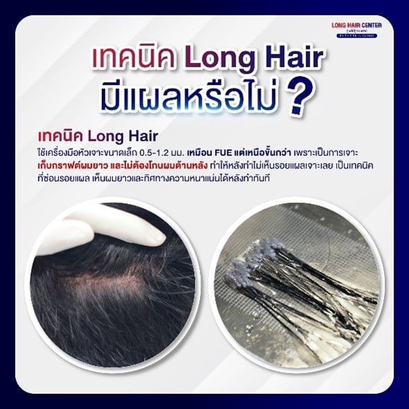 การดูแลหลังการรักษาเพื่อลดการเกิดรอยแผลเป็น?