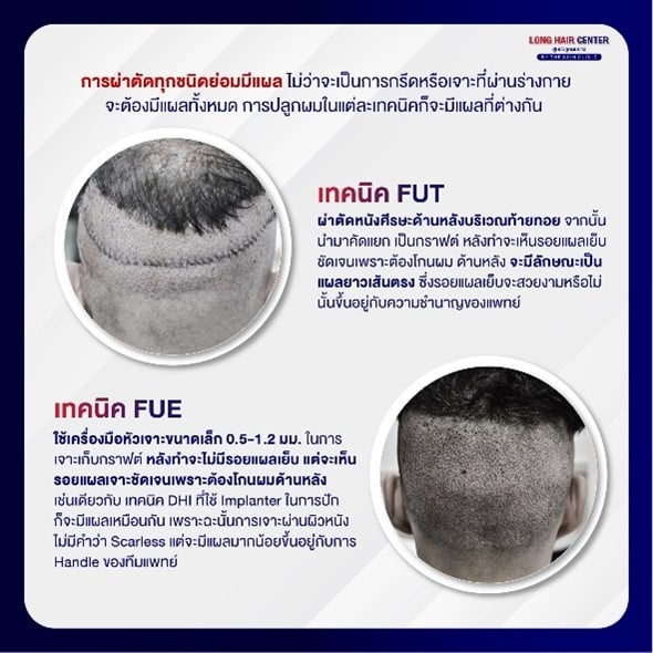 การดูแลหลังการรักษาเพื่อลดการเกิดรอยแผลเป็น?